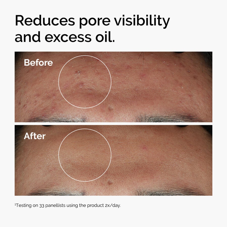 niacinamide-10-zinc-1-r5 ord-niacinamide-zinc-blemish-serum-before-after-pores.jpg