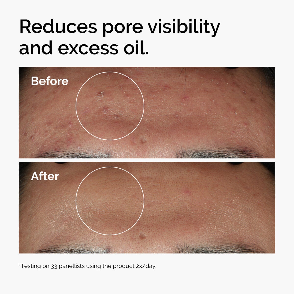 niacinamide-10-zinc-1-r5 ord-niacinamide-zinc-blemish-serum-before-after-pores.jpg