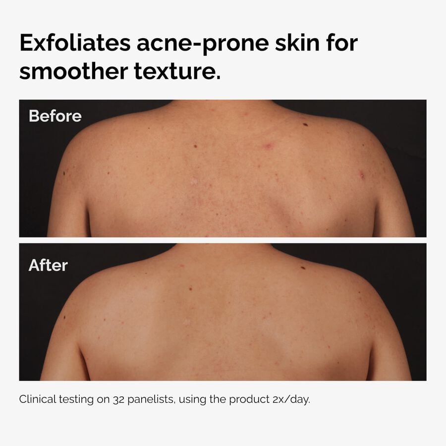 salicylic-acid-0-5-body-serum-h7 ord-salicylic-acid-body-serum-before-after-graphic-NA.jpg