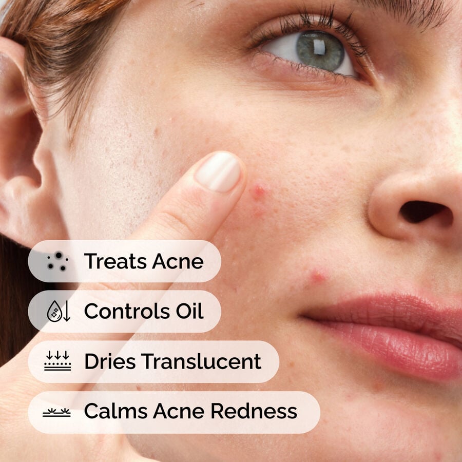sulfur-10-powder-to-cream-concentrate-n9 ord-sulfur-10pct-powder-to-cream-concentrate-model-application-with-benefits-acne.jpg