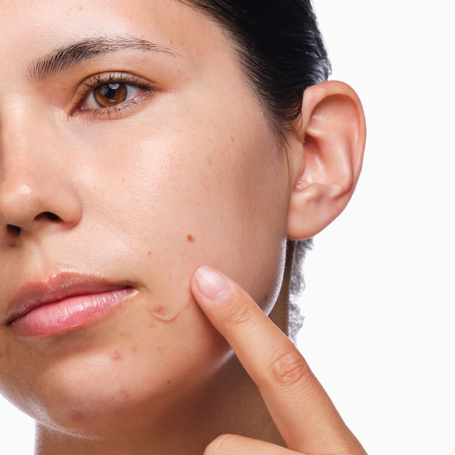 the-acne-set-p6 rdn-the-acne-set-application.png